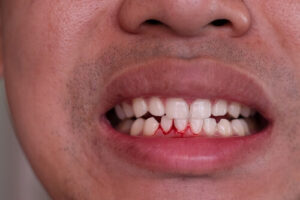 bleeding gums dentist regularly